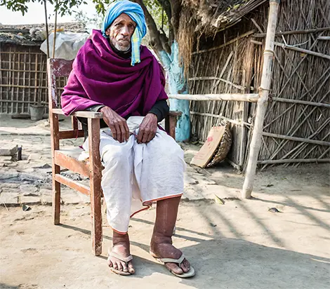 Lymphatic Filariasis